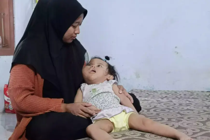 Miris! Balita Probolinggo Sulit Berobat karena Sindrom Proteus Langka